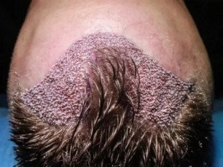 mehmet-cetin-sac-ekimi